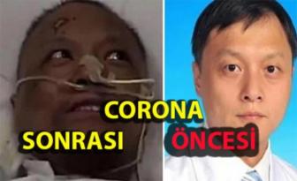 Çin’de koronavirüsü yenen doktorların ten rengi değişti